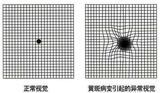 黃斑病變治療最有效最新方法,黃斑病變治療的最有效最新方法